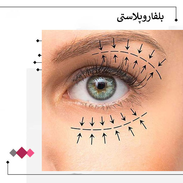 بلفاروپلاستی یا جراحی زیبایی پلک _ دکتر مریم اعتمادی