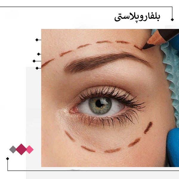 بلفاروپلاستی یا جراحی زیبایی پلک _ دکتر مریم اعتمادی