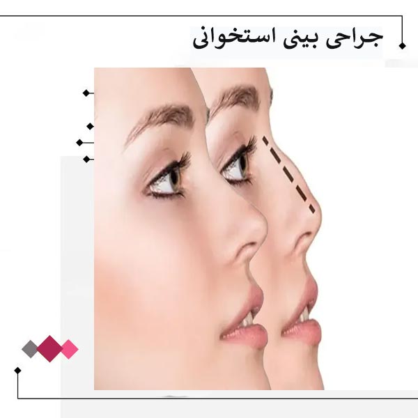 عمل بینی استخوانی _ دکتر مریم اعتمادی