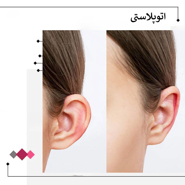 اتوپلاستی یا جراحی زیبایی گوش _ دکتر مریم اعتمادی