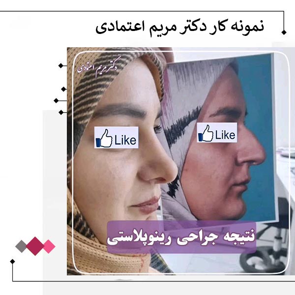 نمونه کار جراح بینی در کرمانشاه _ دکتر مریم اعتمادی
